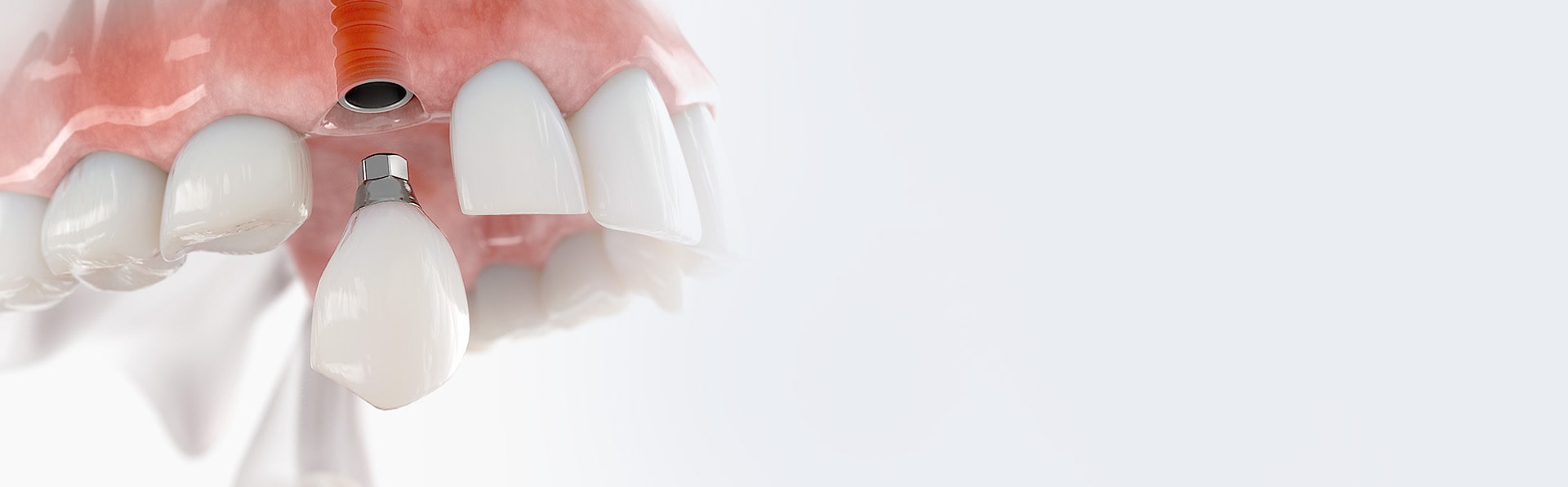 Dental Implants Ottawa  Implant Dentistry Ottawa