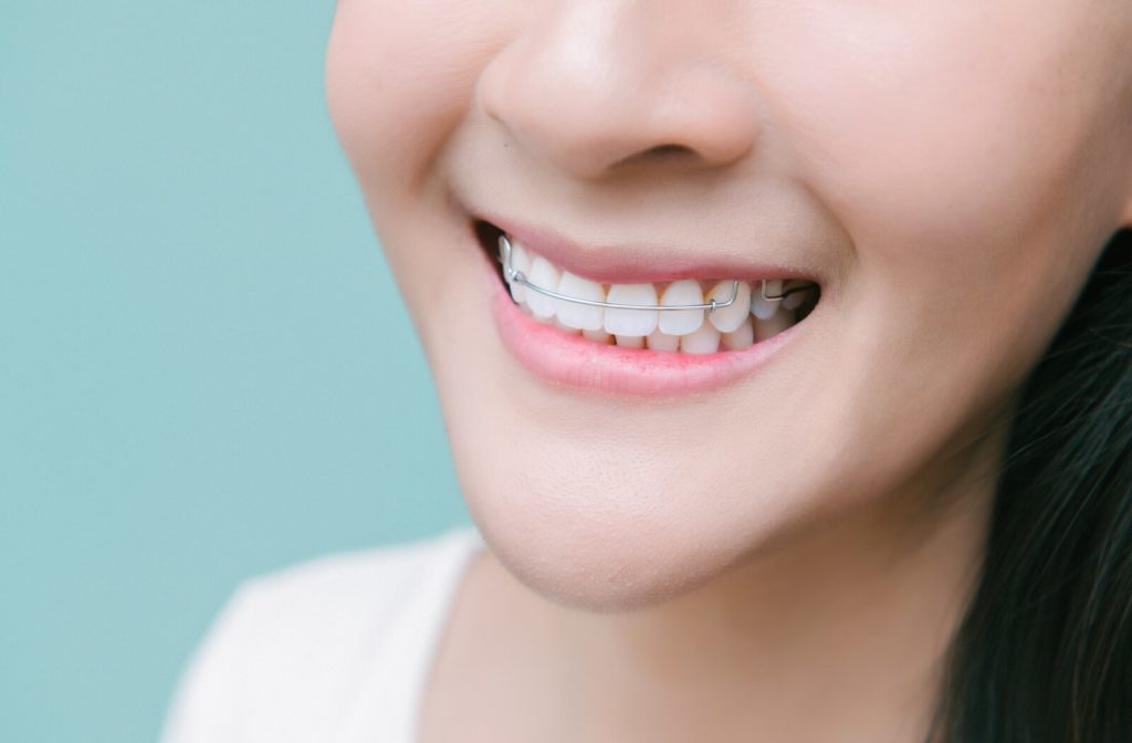 Close up photo of a woman's smile showing her wearing an orthodontic retainer.
