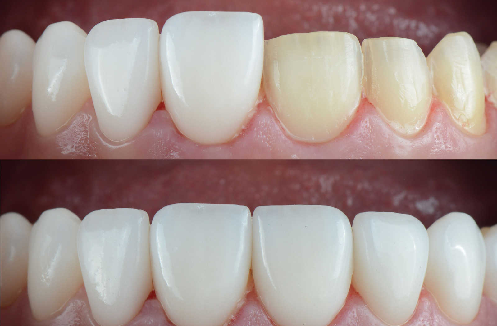Close-up teeth of before and after veneers are installed.