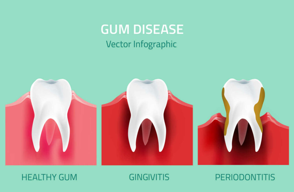 Vector image showing healthy gum, gingivitis, and periodontitis. 