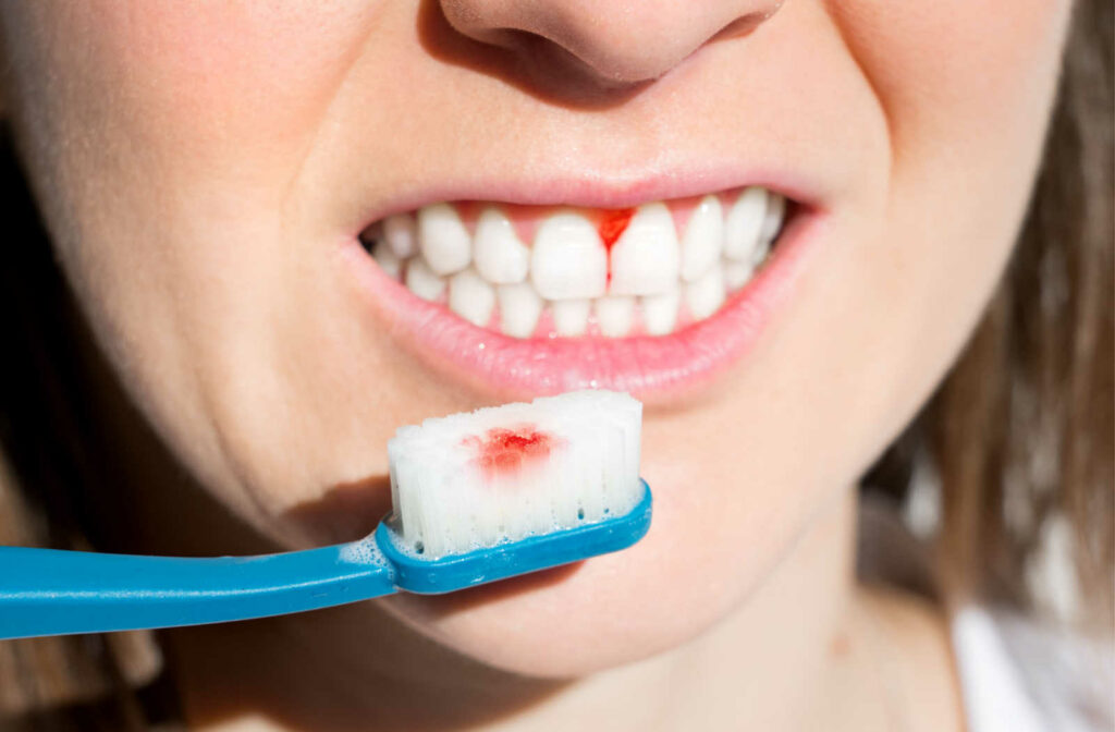 Image of a woman's mouth and tooth brush showing inflamed gums and blood on the toothbrush.