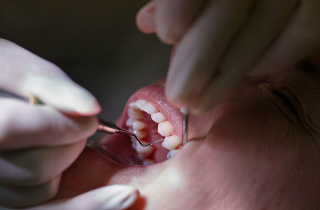 A close-up image of a dentist cleaning a patient's teeth during a dental exam to help prevent gum recession.