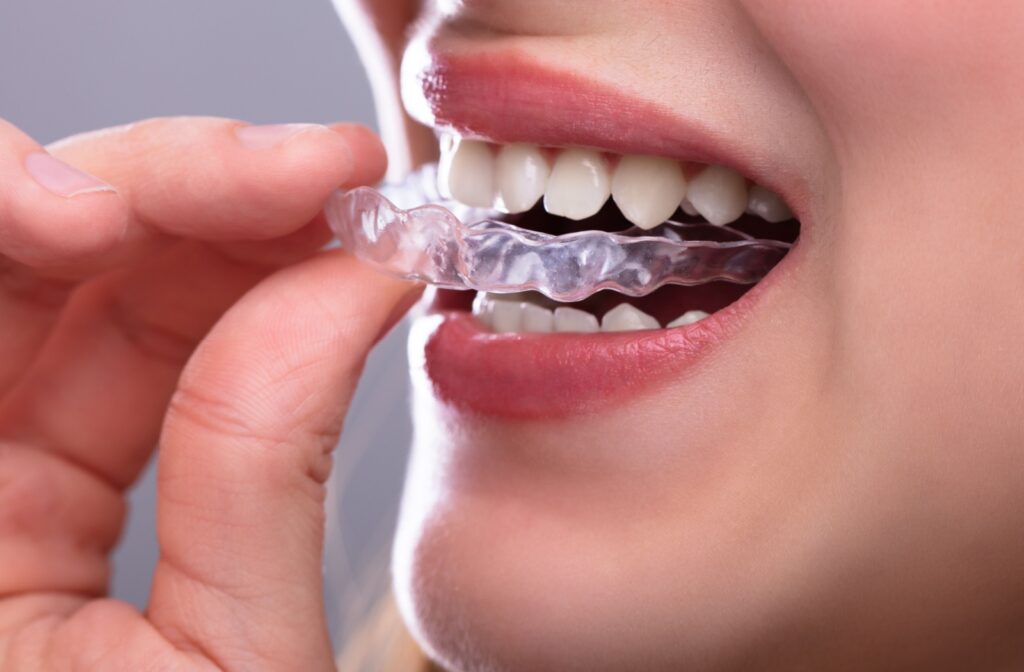 Woman wearing night guard to prevent herself from grinding her teeth due to TMJ disorder.