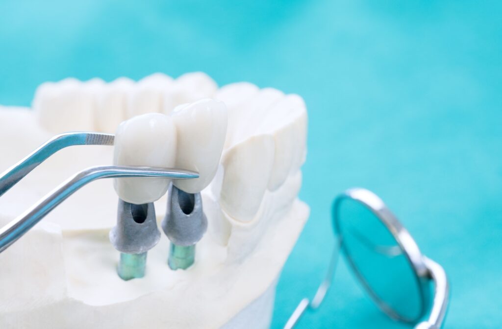 A close-up image of a 3D model showcasing a dental implant bridge.