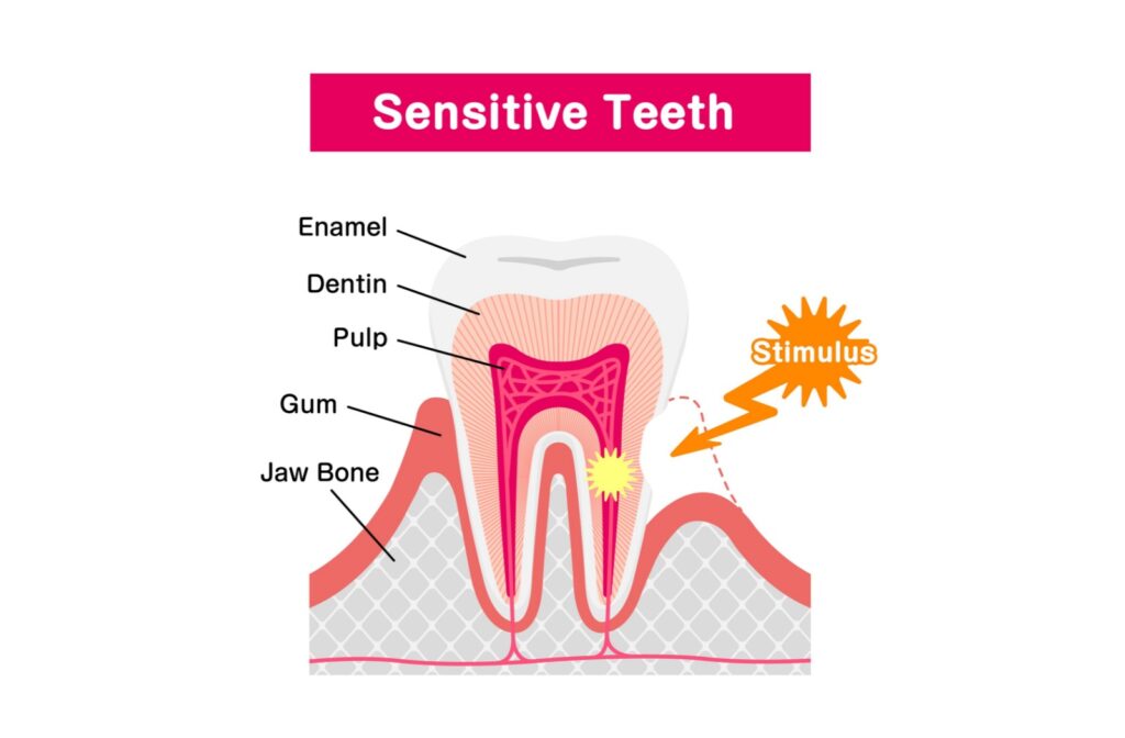 Medical illustration showing tooth anatomy with enamel, dentin, pulp, gum, and jaw bone labeled, explaining how external stimuli cause tooth sensitivity.