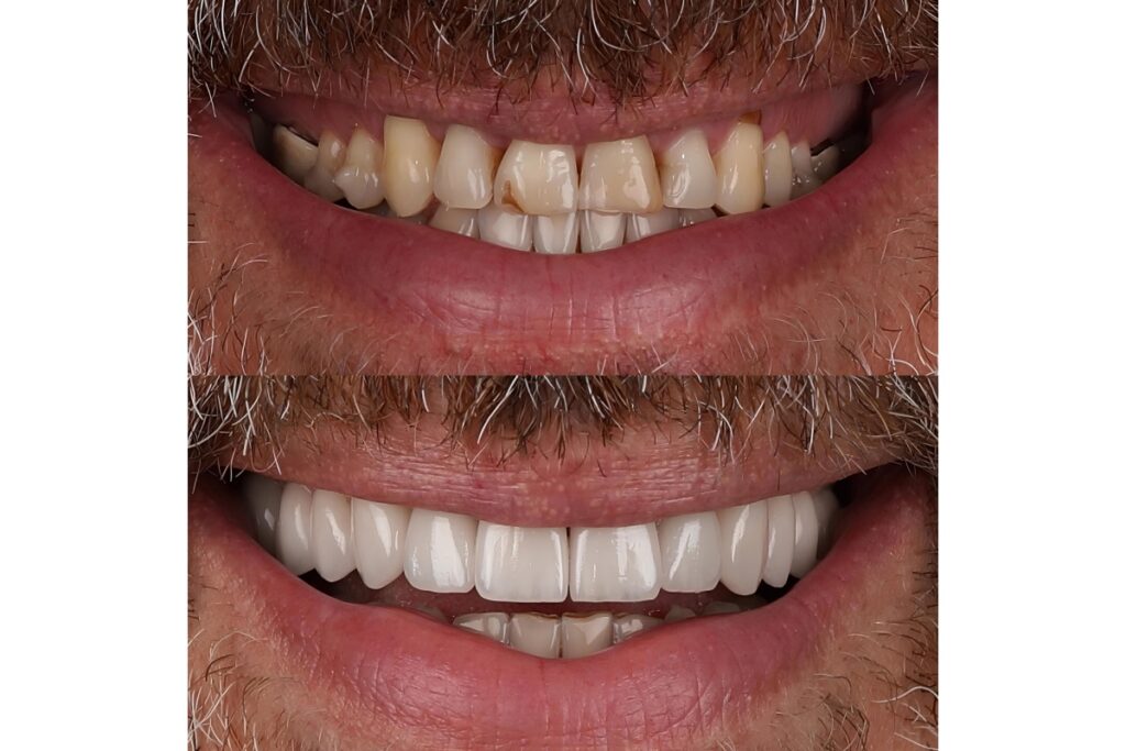 Before and after comparison showing teeth whitening results with discolored teeth transformed to bright white smile.