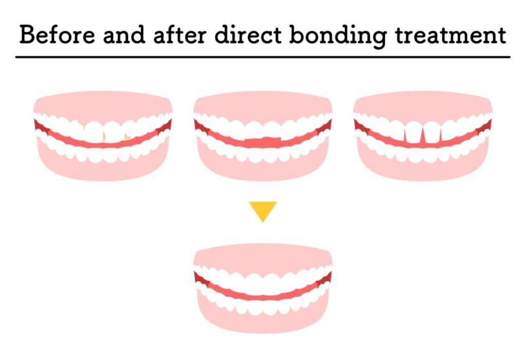 Before and after direct bonding treatment.