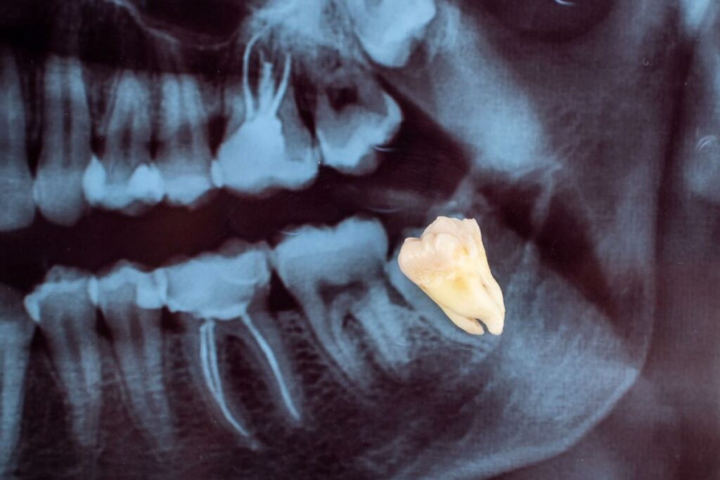 X-ray image with an actual image of a wisdom tooth overlain in its usual spot.